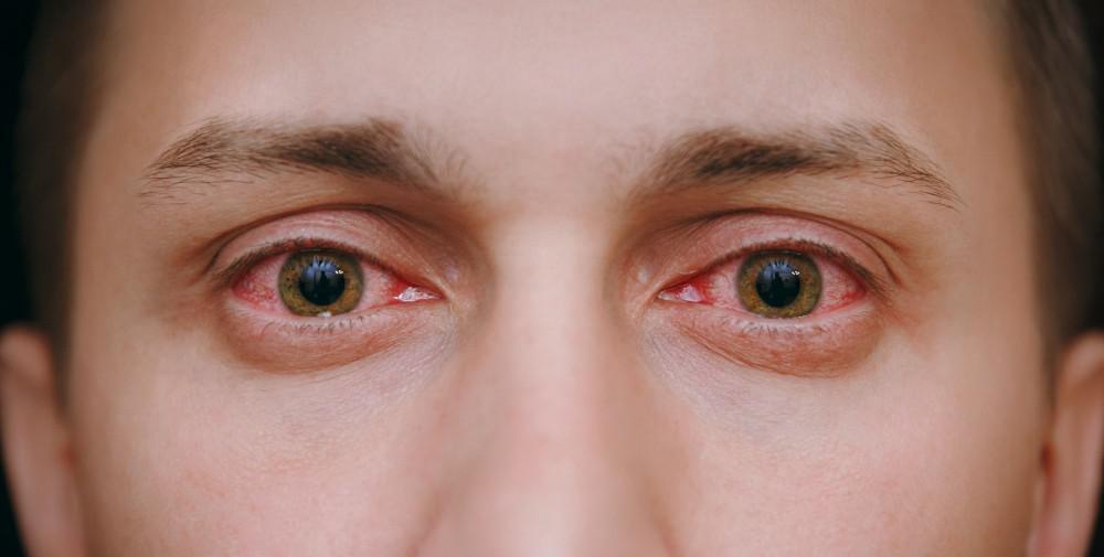 How To Get Rid Of Red Eyes From Weed?