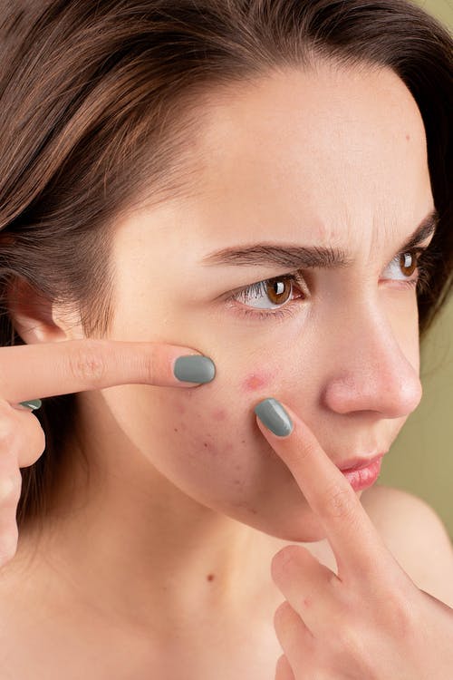 Does Smoking Weed Cause Acne?